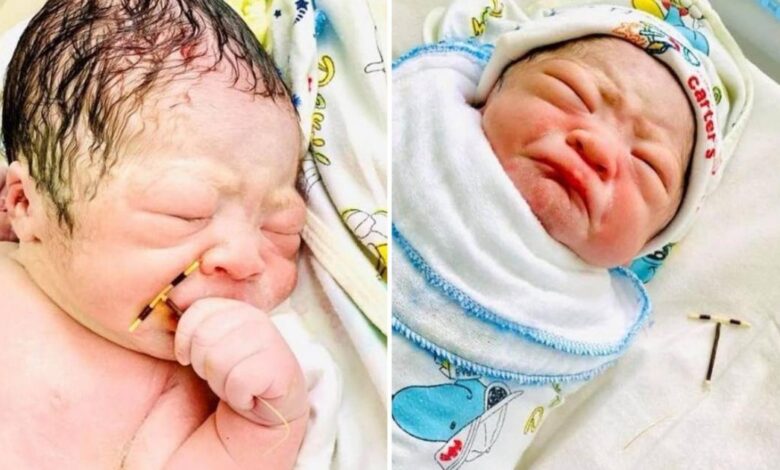 Bebê nasce segurando o DIU que a mãe usava para evitar uma gravidez
